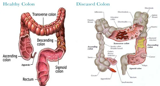 where can i get a colon cleanse near me? 5 colonic machine