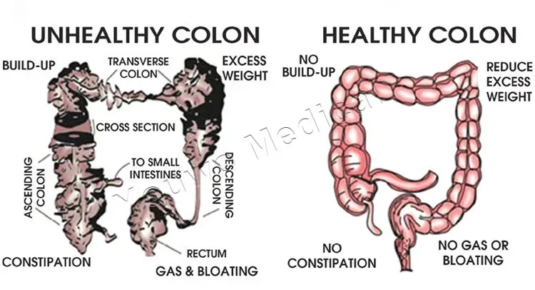 is it safe to do a colon cleanse? 3 where to go to get a colon cleanse