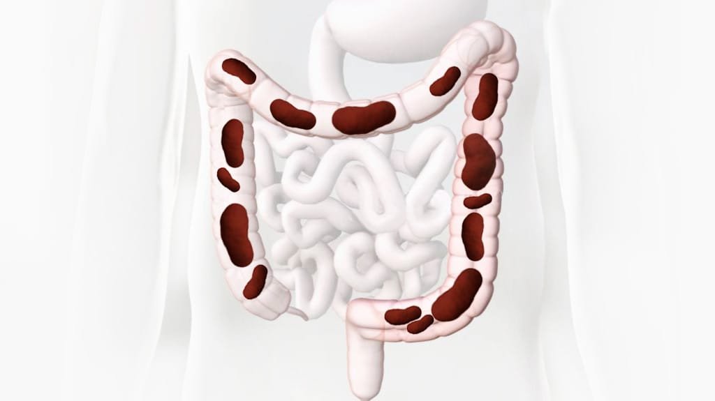 colonic irrigation instruments