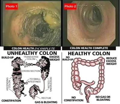 Colonic Health: What's a Colonic Machine? 2 What's a Colonic Machine